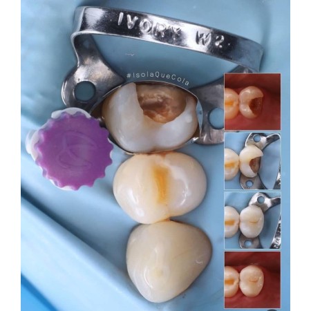 Polydentia - myQuickmat All Round Matrices PreMolar